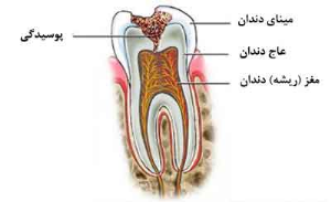 پوسیدگی دندان | چرا و چگونه؟